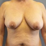 Breast Lift with Implant (Augmentation Mastopexy) Before & After Patient #11206