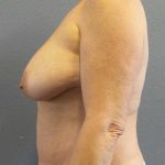 Breast Lift with Implant (Augmentation Mastopexy) Before & After Patient #11206