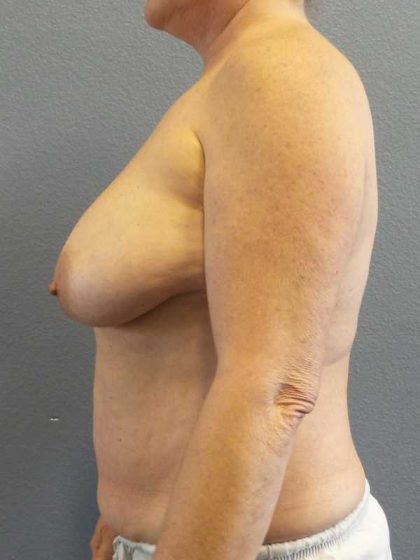 Breast Lift with Implant (Augmentation Mastopexy) Before & After Patient #11206