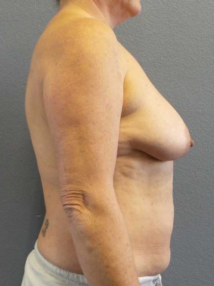Breast Lift with Implant (Augmentation Mastopexy) Before & After Patient #11206