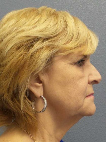 Facelift Before & After Patient #11614