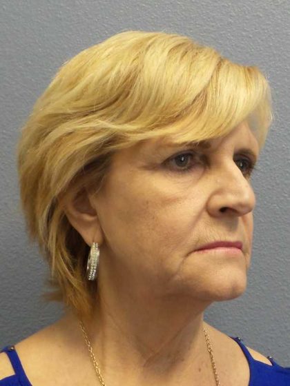 Facelift Before & After Patient #11614