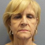 Facelift Before & After Patient #11614