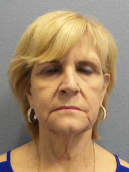 Facelift Before & After Patient #11614