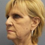 Facelift Before & After Patient #11614