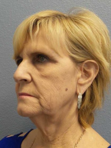 Facelift Before & After Patient #11614
