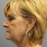 Facelift Before & After Patient #11614
