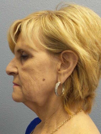 Facelift Before & After Patient #11614