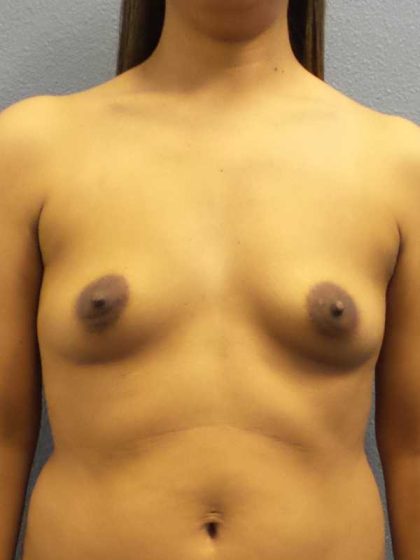 Breast Augmentation Before & After Patient #11356