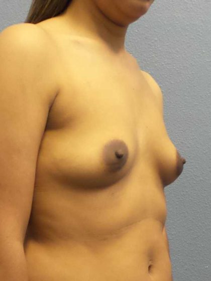 Breast Augmentation Before & After Patient #11356