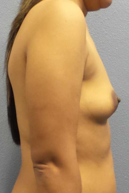 Breast Augmentation Before & After Patient #11356