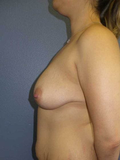 Breast Lift with Implant (Augmentation Mastopexy) Before & After Patient #4482