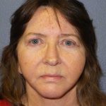 Facelift Before & After Patient #11820
