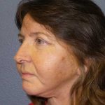 Facelift Before & After Patient #11820