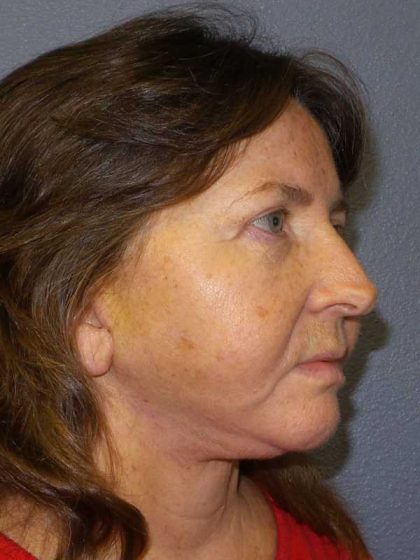 Facelift Before & After Patient #11820