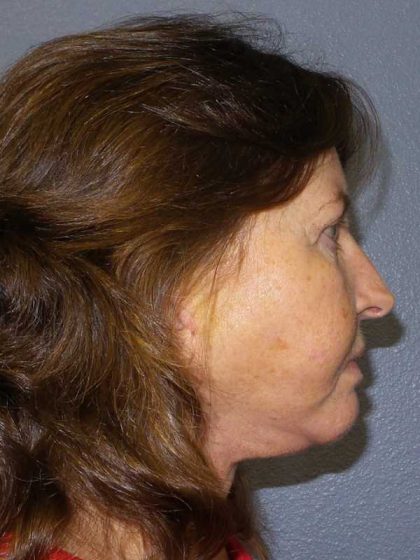 Facelift Before & After Patient #11820