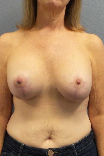 Mastopexy (Breast Lift) Before & After Patient #12235