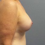 Mastopexy (Breast Lift) Before & After Patient #12235