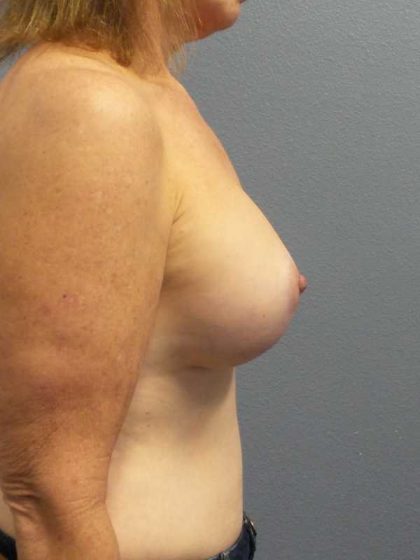 Mastopexy (Breast Lift) Before & After Patient #12235