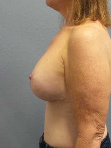 Mastopexy (Breast Lift) Before & After Patient #12235