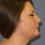 Liposuction of the Neck Before & After Patient #12214