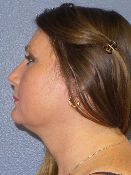 Liposuction of the Neck Before & After Patient #12214
