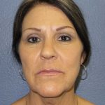 Facelift Before & After Patient #11853