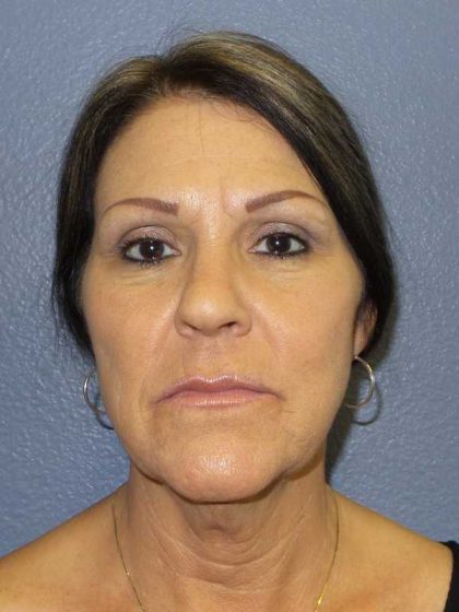 Facelift Before & After Patient #11853