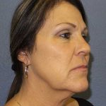 Facelift Before & After Patient #11853