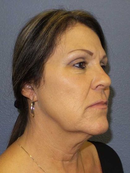 Facelift Before & After Patient #11853