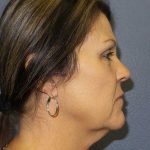 Facelift Before & After Patient #11853