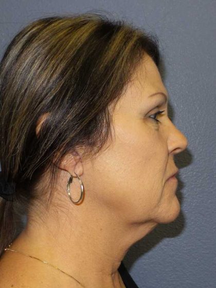 Facelift Before & After Patient #11853