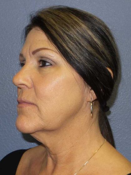 Facelift Before & After Patient #11853