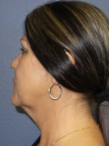 Facelift Before & After Patient #11853