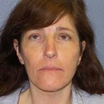 Facelift Before & After Patient #11792