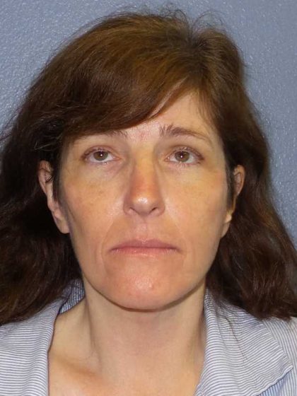 Facelift Before & After Patient #11792