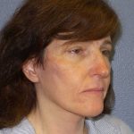 Facelift Before & After Patient #11792