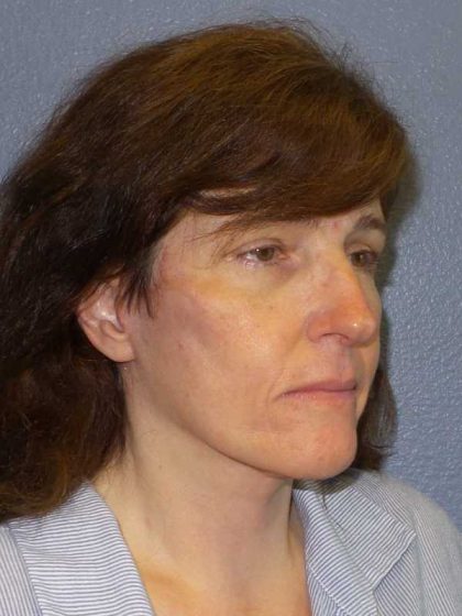 Facelift Before & After Patient #11792
