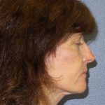 Facelift Before & After Patient #11792