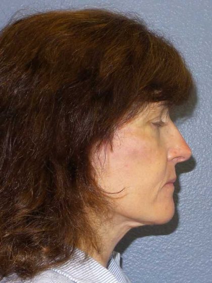Facelift Before & After Patient #11792
