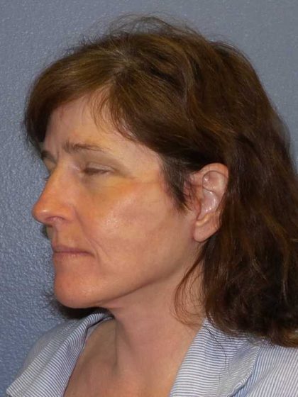 Facelift Before & After Patient #11792