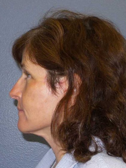 Facelift Before & After Patient #11792