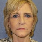 Facelift Before & After Patient #11614