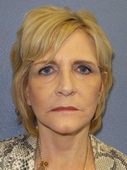 Facelift Before & After Patient #11614