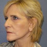 Facelift Before & After Patient #11614
