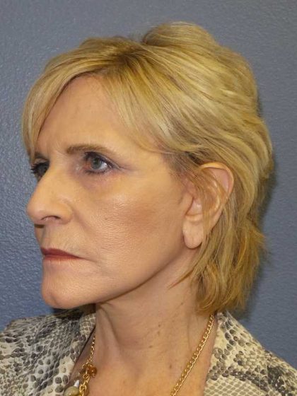 Facelift Before & After Patient #11614