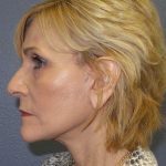 Facelift Before & After Patient #11614