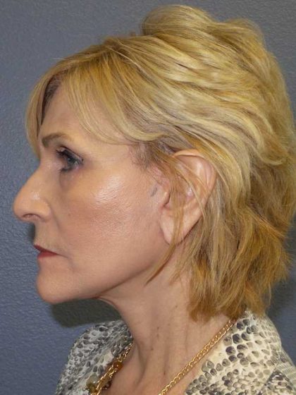 Facelift Before & After Patient #11614