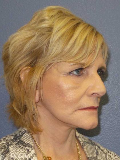 Facelift Before & After Patient #11614