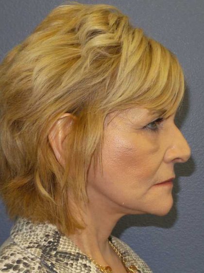 Facelift Before & After Patient #11614